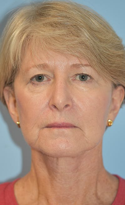 Facelift/Necklift Before & After Gallery - Patient 311543 - Image 2