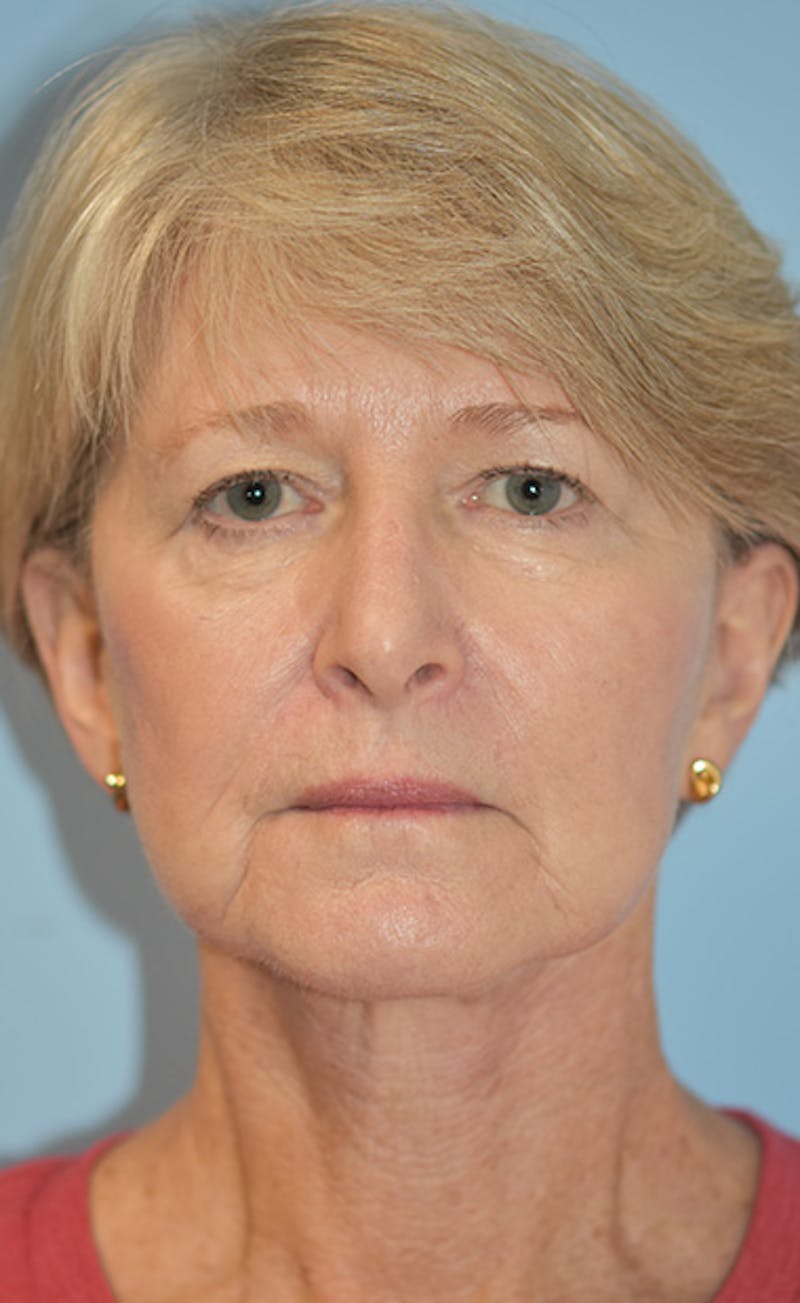 Facelift/Necklift Before & After Gallery - Patient 311543 - Image 2