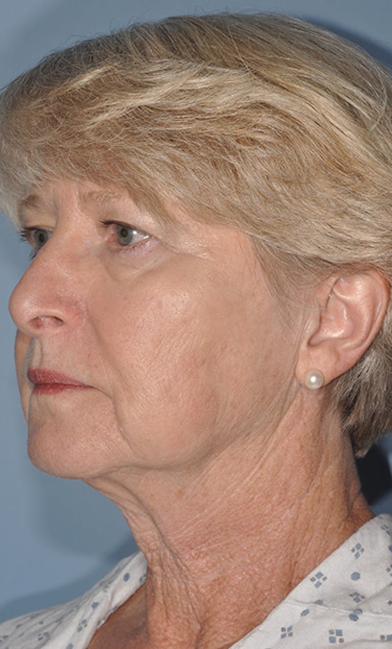 Facelift/Necklift Before & After Gallery - Patient 311543 - Image 3