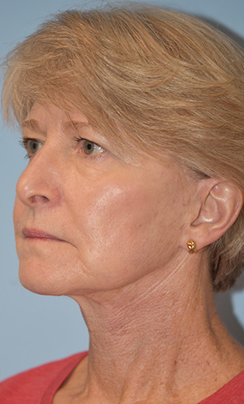 Facelift/Necklift Before & After Gallery - Patient 311543 - Image 4