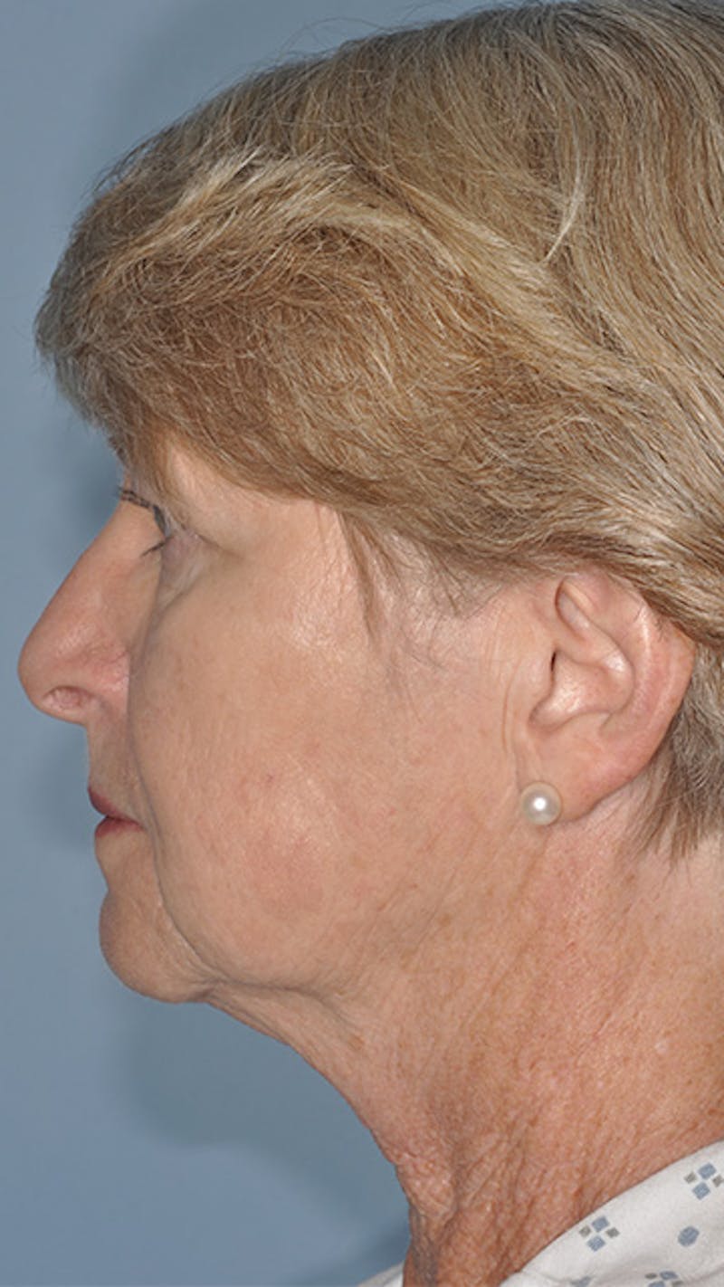 Facelift/Necklift Before & After Gallery - Patient 311543 - Image 5