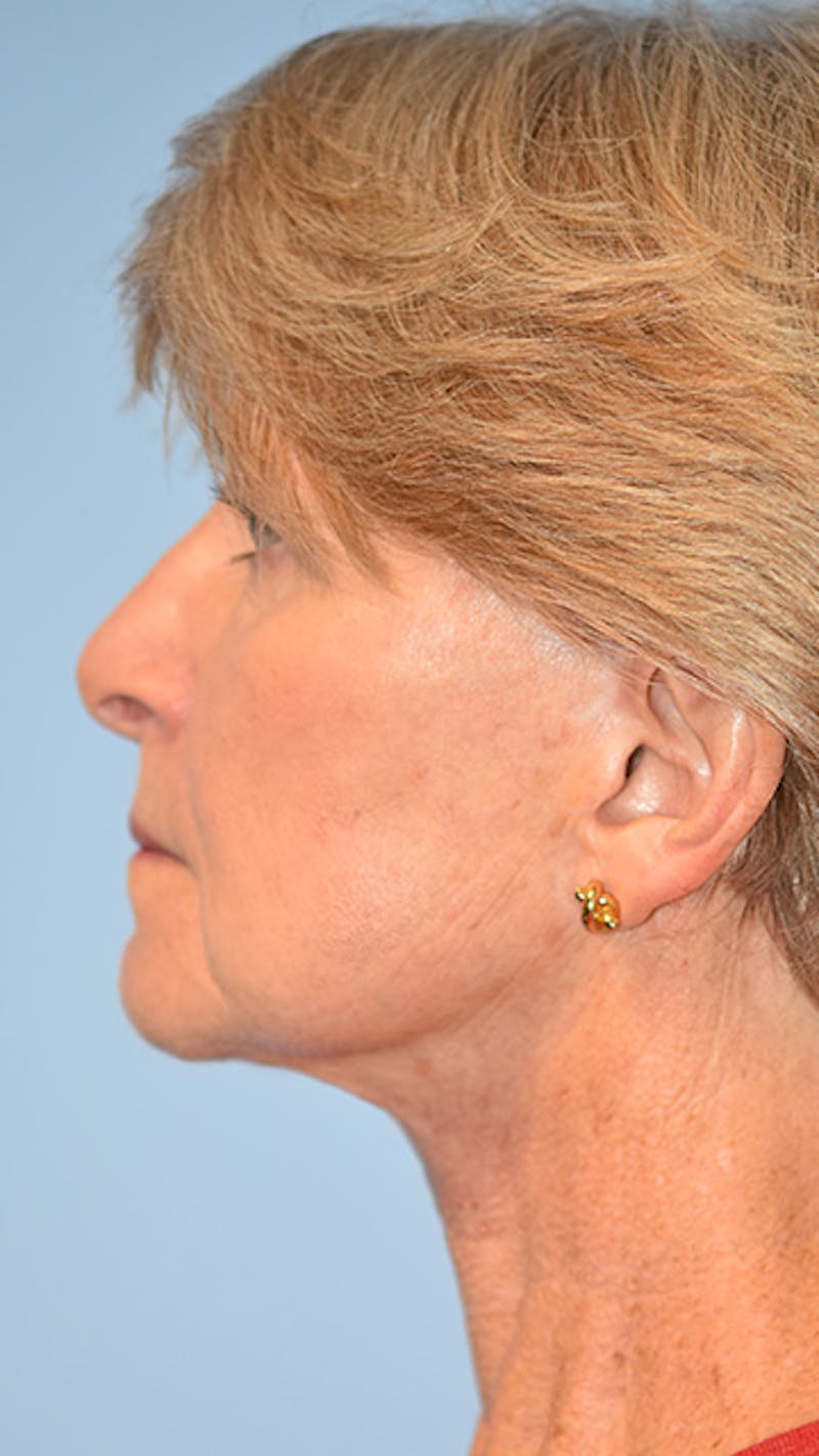 Facelift/Necklift Before & After Gallery - Patient 311543 - Image 6