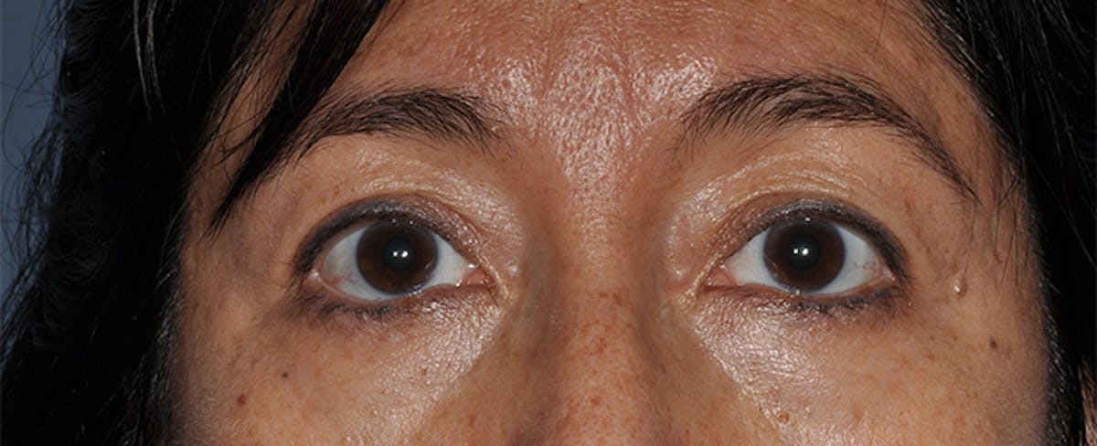 Eyelid Surgery (Blepharoplasty) Before & After Gallery - Patient 227924 - Image 1