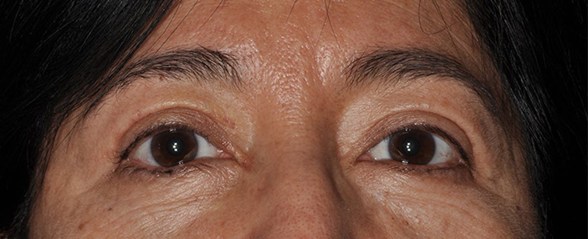 Eyelid Surgery (Blepharoplasty) Before & After Gallery - Patient 227924 - Image 2