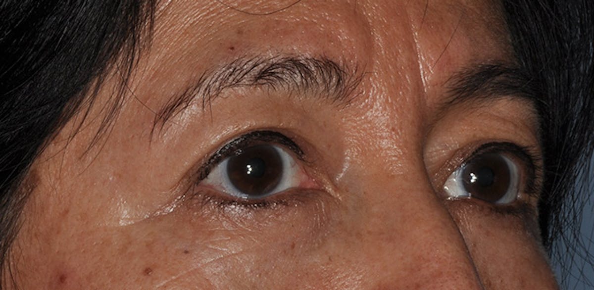 Eyelid Surgery (Blepharoplasty) Before & After Gallery - Patient 227924 - Image 3