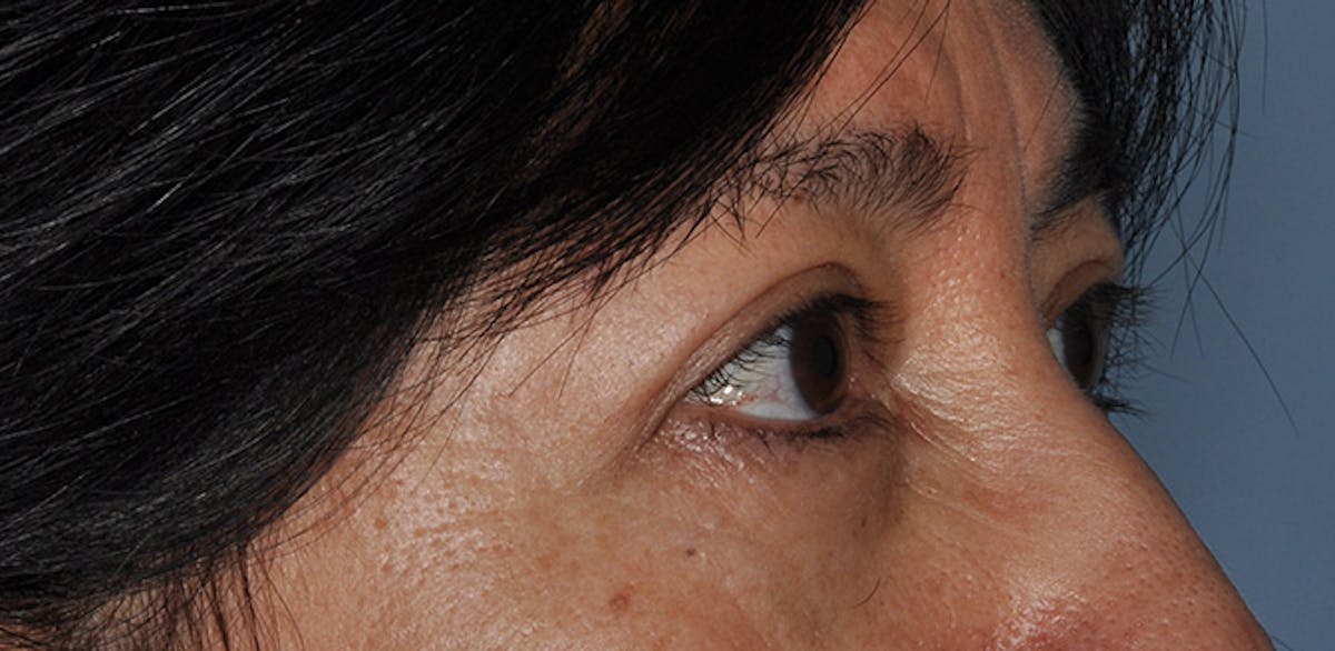 Eyelid Surgery (Blepharoplasty) Before & After Gallery - Patient 227924 - Image 4