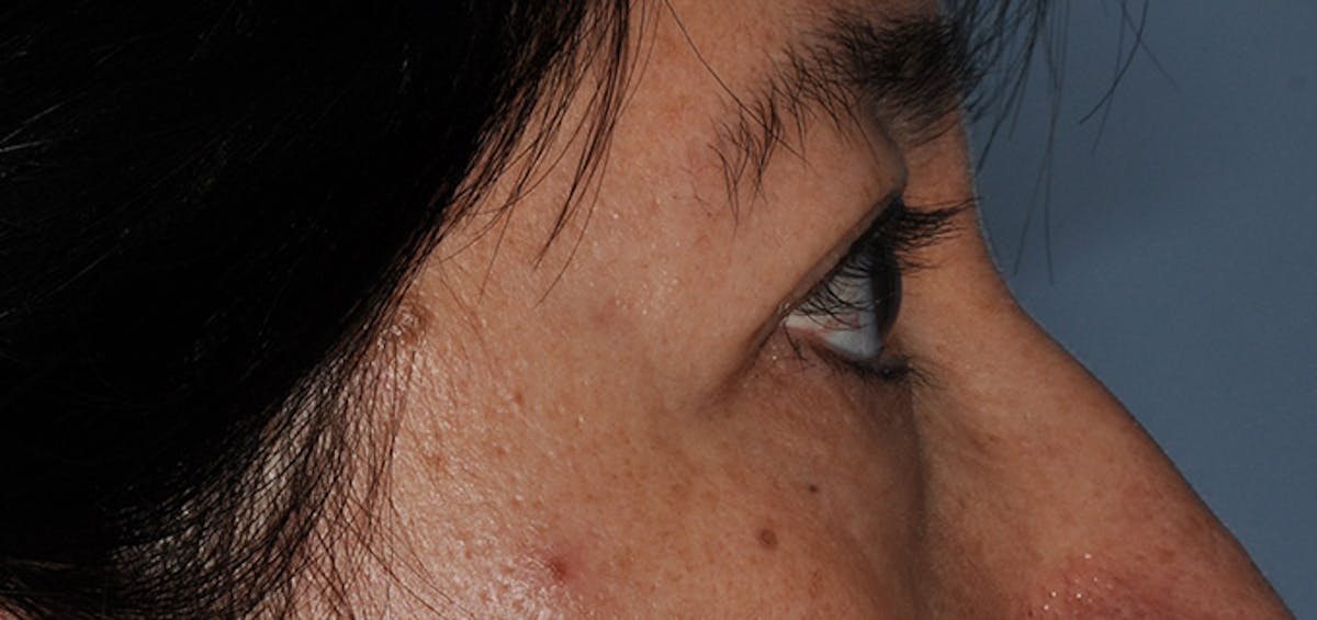Eyelid Surgery (Blepharoplasty) Before & After Gallery - Patient 227924 - Image 5