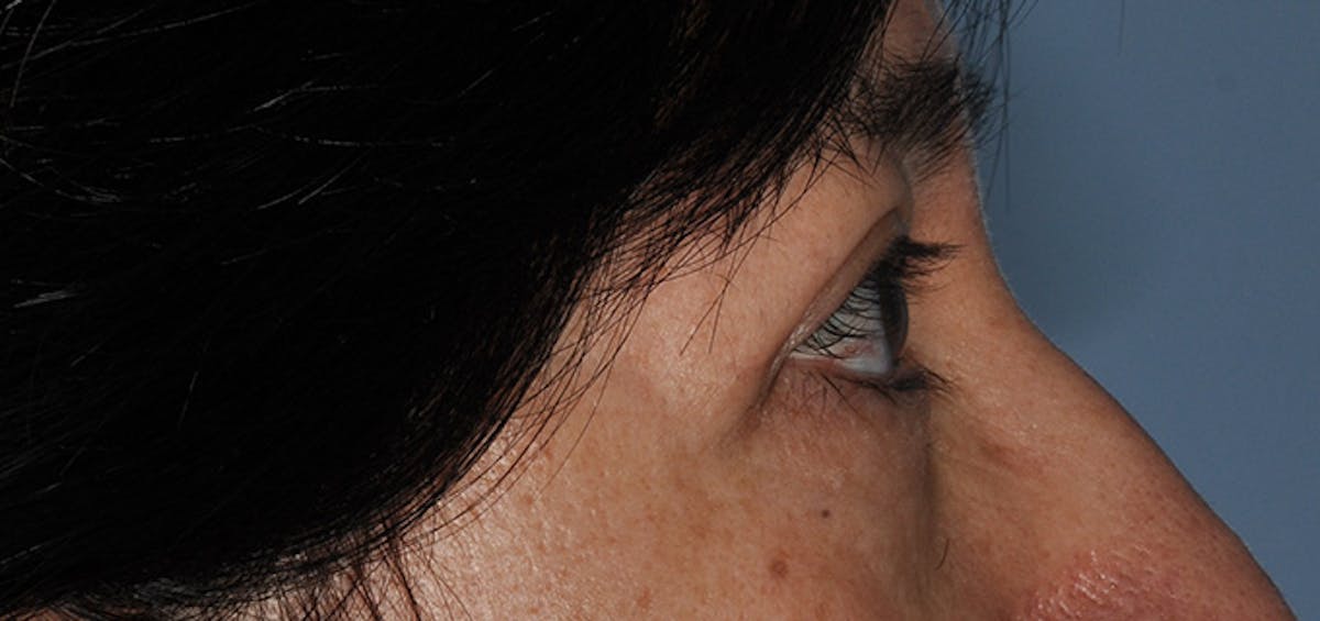 Eyelid Surgery (Blepharoplasty) Before & After Gallery - Patient 227924 - Image 6