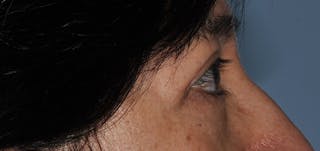 Eyelid Surgery (Blepharoplasty) Before & After Gallery - Patient 227924 - Image 6