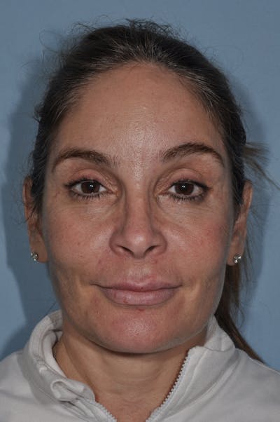 Facial Fat Grafting Before & After Gallery - Patient 246233 - Image 1
