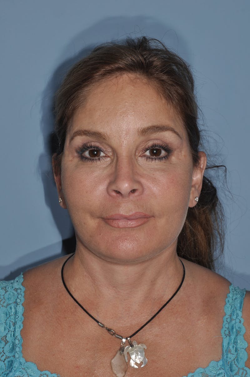 Facial Fat Grafting Before & After Gallery - Patient 246233 - Image 2