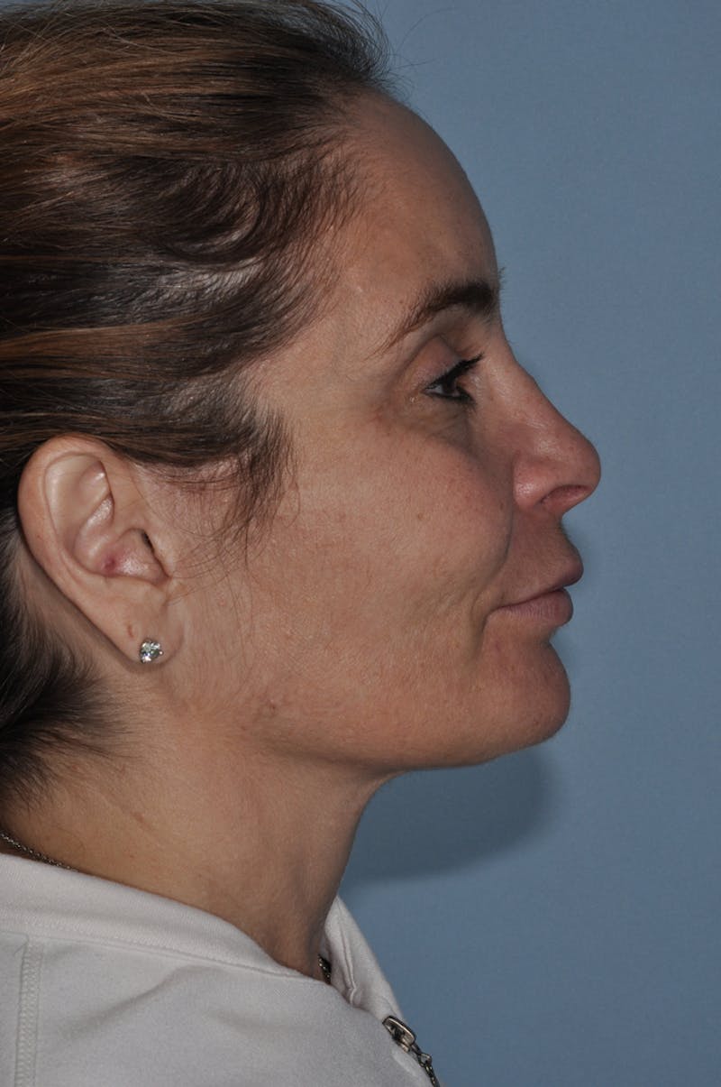 Facial Fat Grafting Before & After Gallery - Patient 246233 - Image 3