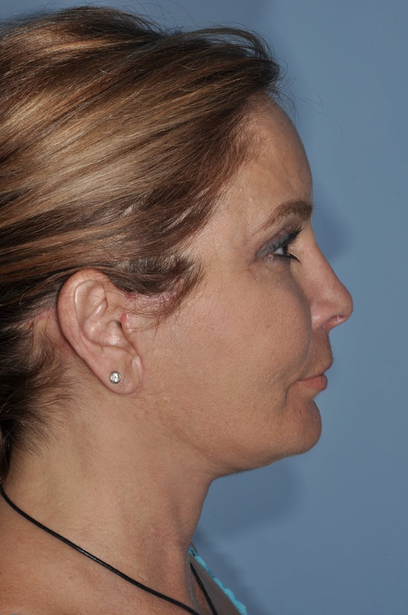 Facial Fat Grafting Before & After Gallery - Patient 246233 - Image 4