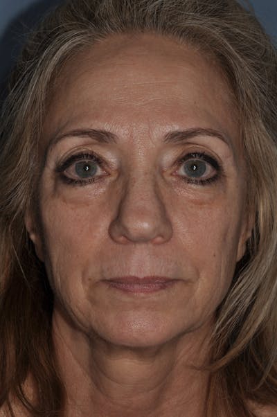 Facial Fat Grafting Before & After Gallery - Patient 327447 - Image 1
