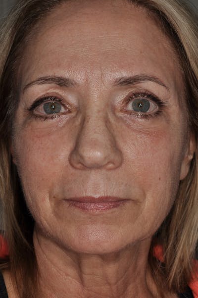 Facial Fat Grafting Before & After Gallery - Patient 327447 - Image 2