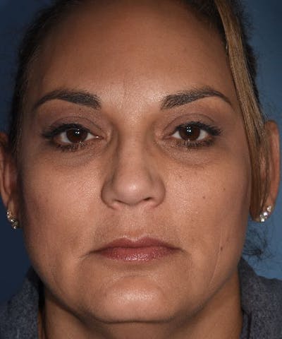 Laser Lower Eyelid Before & After Gallery - Patient 795977 - Image 1