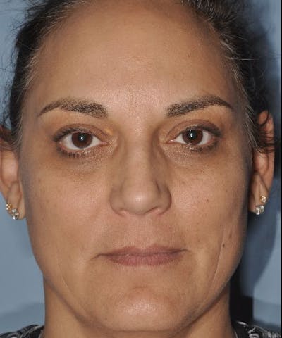 Laser Lower Eyelid Before & After Gallery - Patient 795977 - Image 2