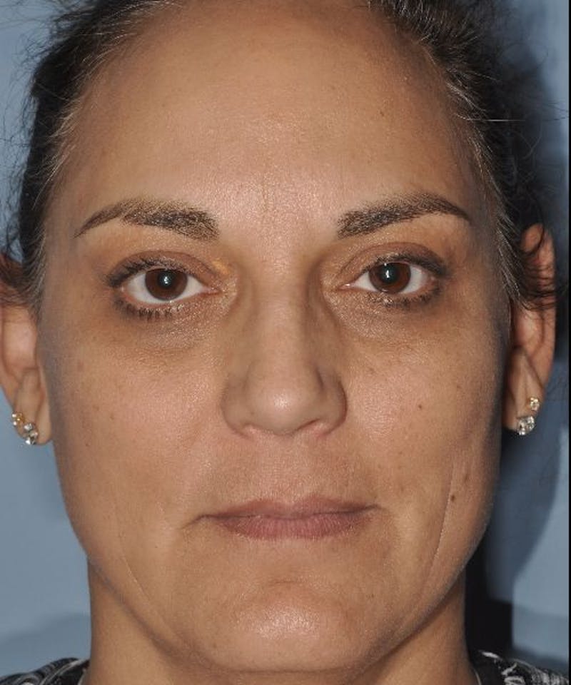 Laser Lower Eyelid Before & After Gallery - Patient 795977 - Image 2