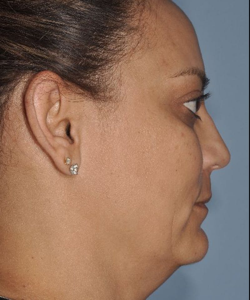 Laser Lower Eyelid Before & After Gallery - Patient 795977 - Image 4
