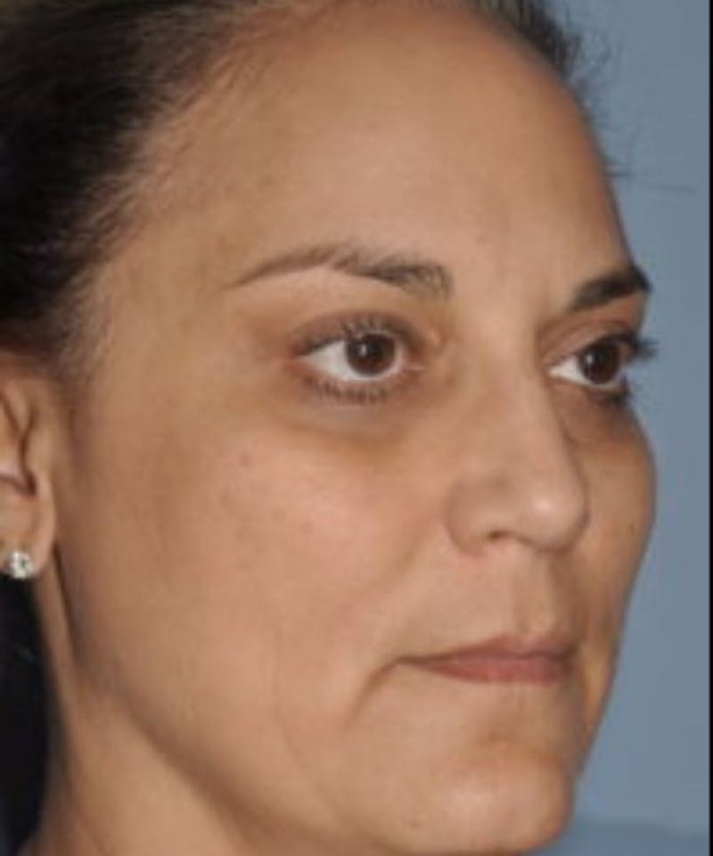 Laser Lower Eyelid Before & After Gallery - Patient 795977 - Image 6