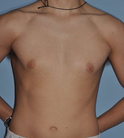 Gynecomastia Before & After Gallery - Patient 379852 - Image 1