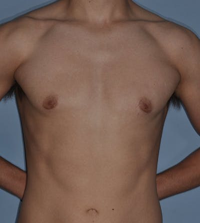 Gynecomastia Before & After Gallery - Patient 379852 - Image 2