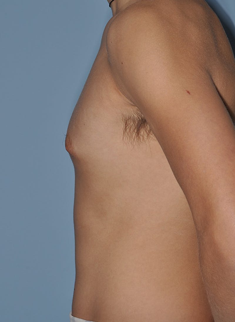 Gynecomastia Before & After Gallery - Patient 379852 - Image 3