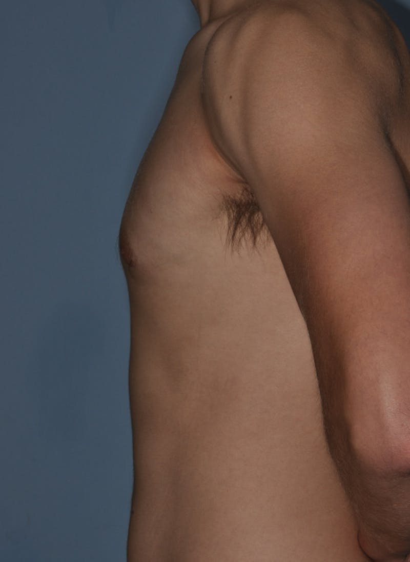 Gynecomastia Before & After Gallery - Patient 379852 - Image 4