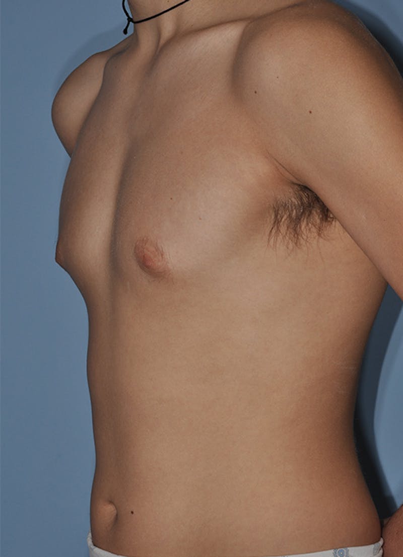 Gynecomastia Before & After Gallery - Patient 379852 - Image 5