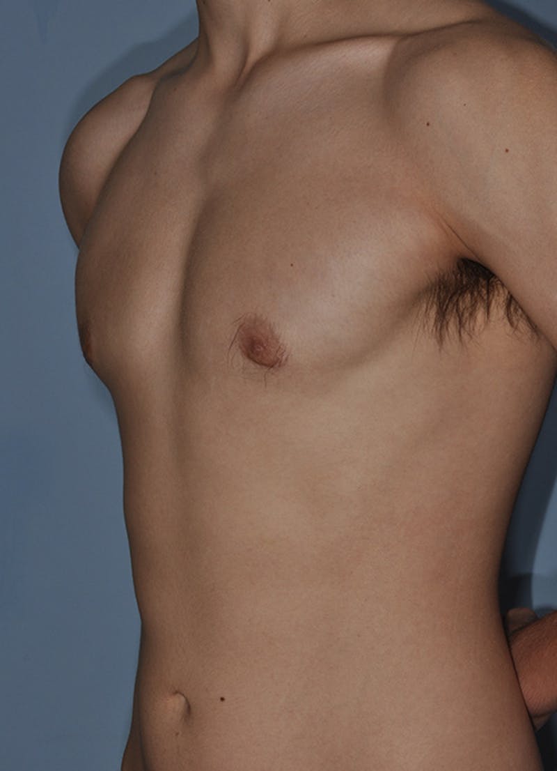 Gynecomastia Before & After Gallery - Patient 379852 - Image 6
