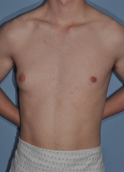 Gynecomastia Before & After Gallery - Patient 998046 - Image 1