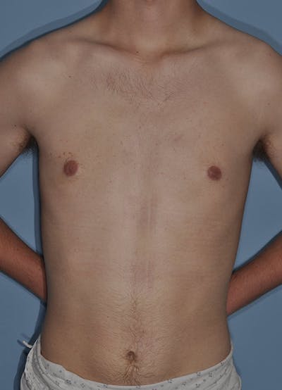Gynecomastia Before & After Gallery - Patient 998046 - Image 2