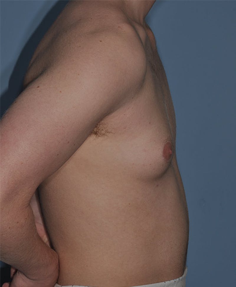 Gynecomastia Before & After Gallery - Patient 998046 - Image 3
