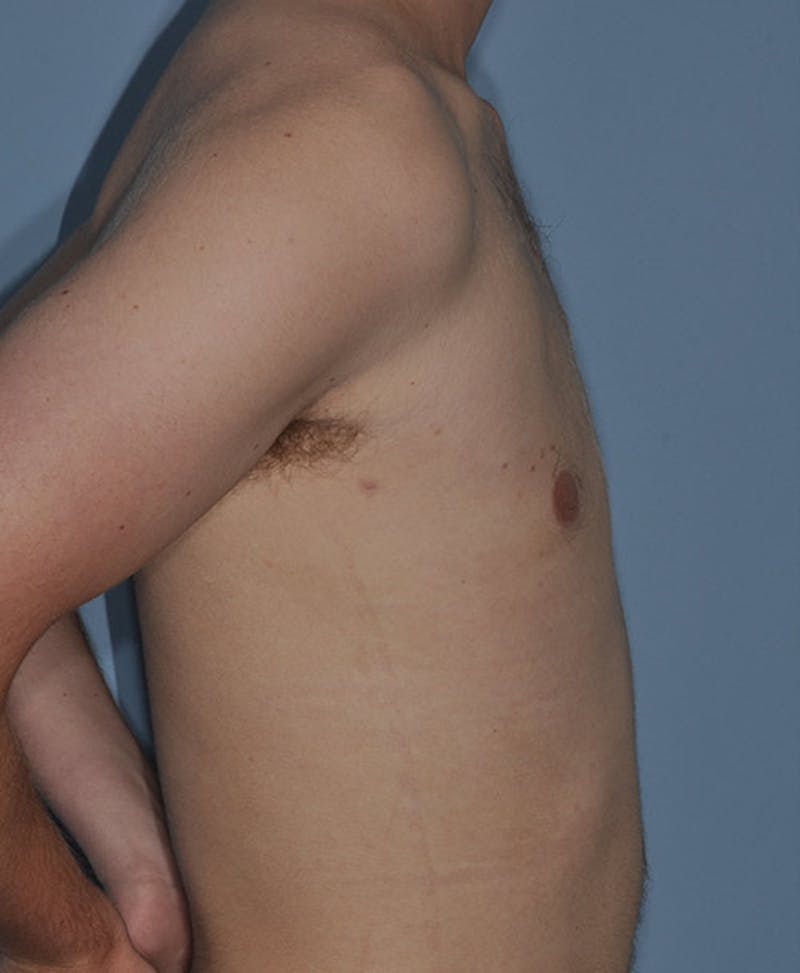 Gynecomastia Before & After Gallery - Patient 998046 - Image 4