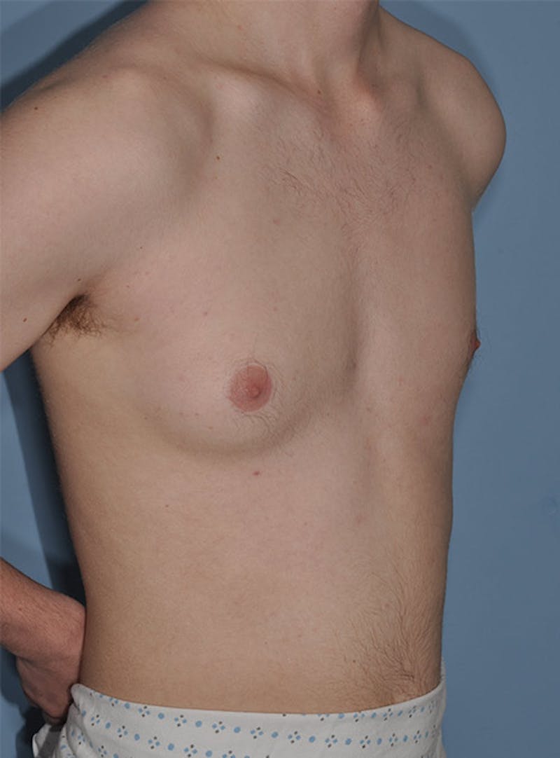 Gynecomastia Before & After Gallery - Patient 998046 - Image 5