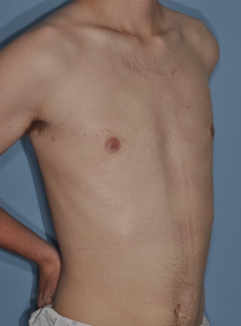 Gynecomastia Before & After Gallery - Patient 998046 - Image 6