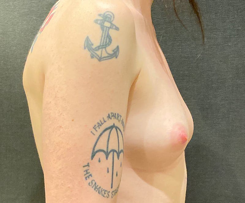 Breast Augmentation Before & After Gallery - Patient 240173 - Image 5
