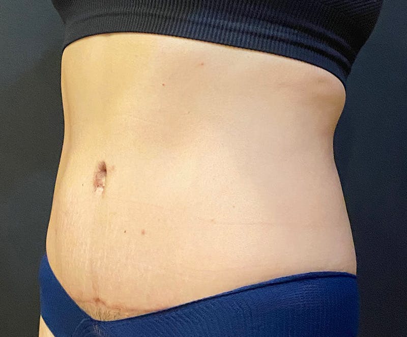 Tummy Tuck (Abdominoplasty) Before & After Gallery - Patient 232439 - Image 4