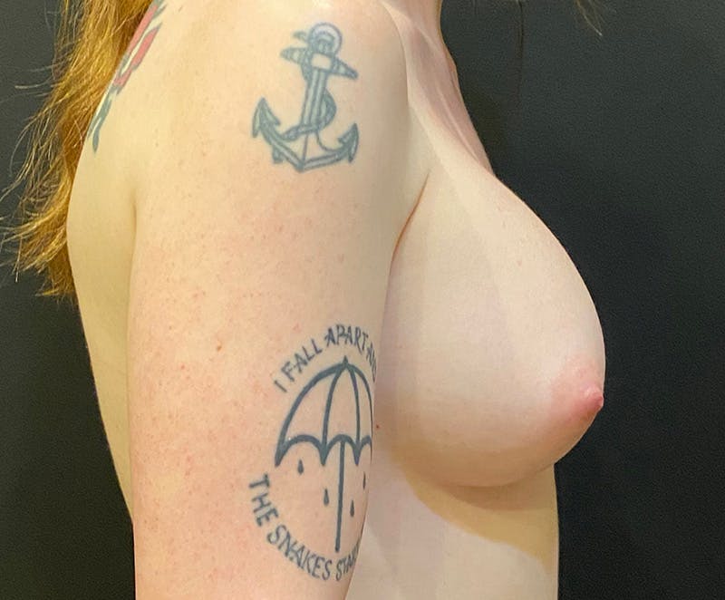 Breast Augmentation Before & After Gallery - Patient 240173 - Image 6
