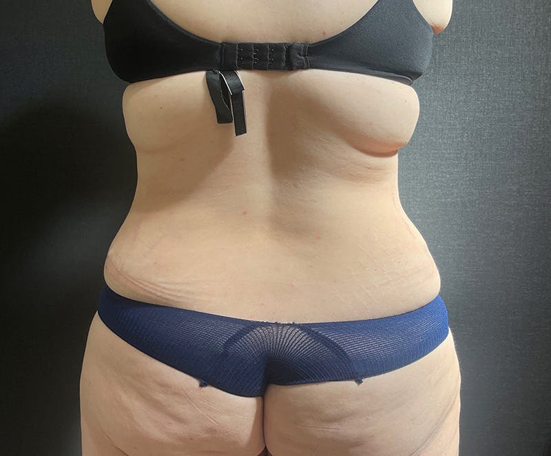 Tummy Tuck (Abdominoplasty) Before & After Gallery - Patient 134632 - Image 12