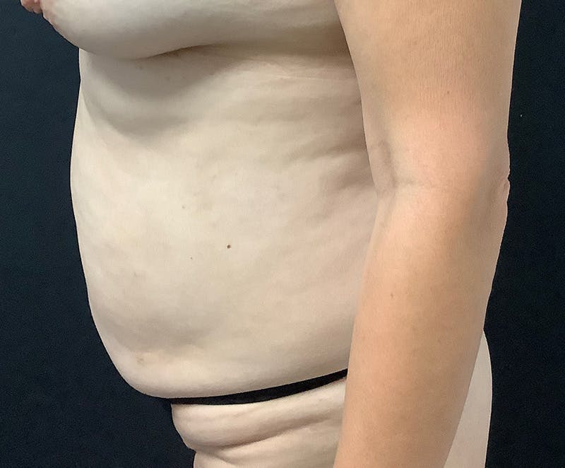 Tummy Tuck (Abdominoplasty) Before & After Gallery - Patient 321974 - Image 5