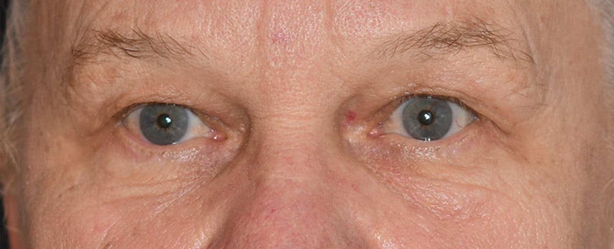 Eyelid Surgery (Blepharoplasty) Before & After Gallery - Patient 338492 - Image 1