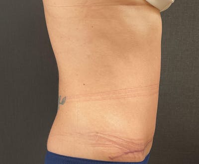 Tummy Tuck (Abdominoplasty) Before & After Gallery - Patient 393314 - Image 2