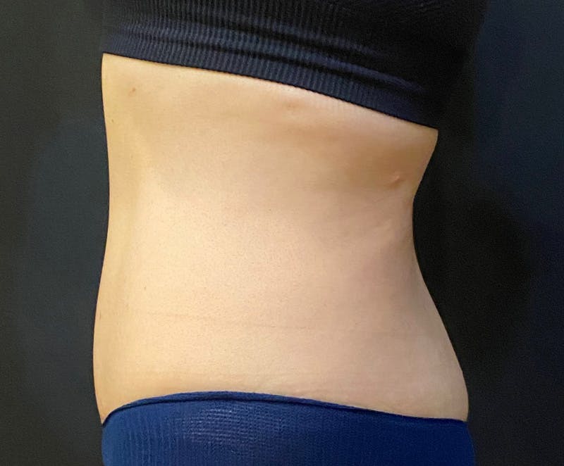 Tummy Tuck (Abdominoplasty) Before & After Gallery - Patient 232439 - Image 6