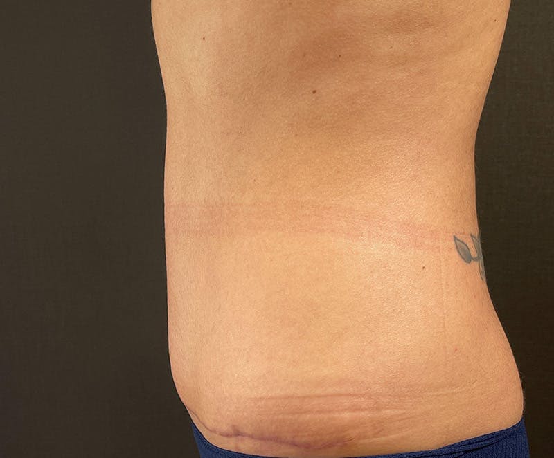 Tummy Tuck (Abdominoplasty) Before & After Gallery - Patient 393314 - Image 4