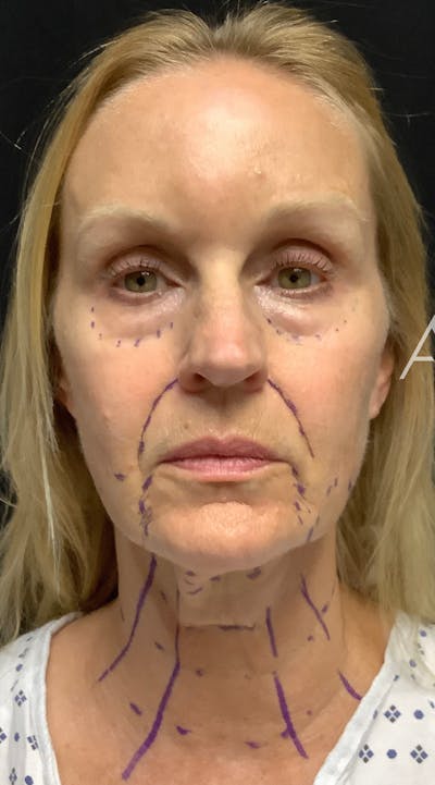 Facelift Before & After Gallery - Patient 208242 - Image 1