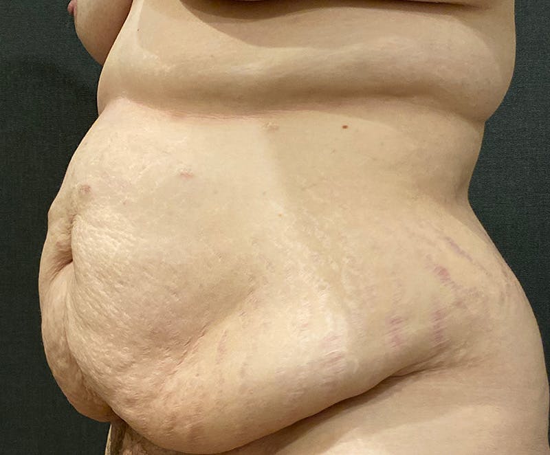 Tummy Tuck (Abdominoplasty) Before & After Gallery - Patient 134632 - Image 7