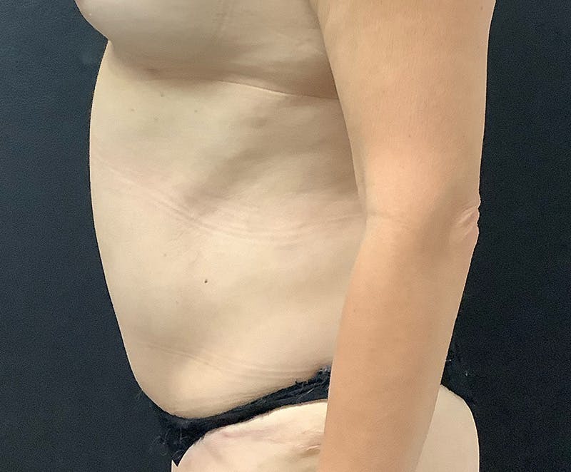 Tummy Tuck (Abdominoplasty) Before & After Gallery - Patient 321974 - Image 6