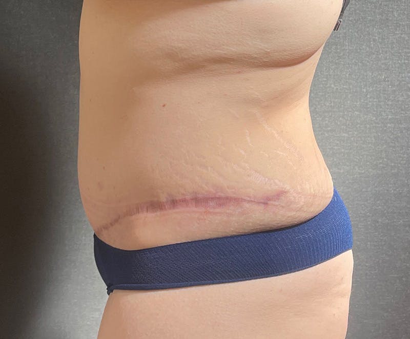 Tummy Tuck (Abdominoplasty) Before & After Gallery - Patient 134632 - Image 10