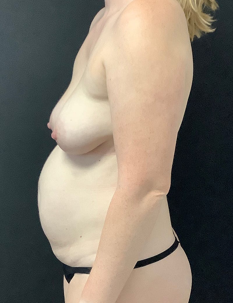 Mommy Makeover Before & After Gallery - Patient 233935 - Image 5